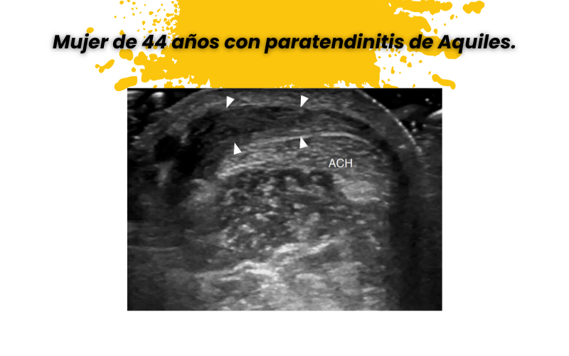 5. Tendon aquiles ecografia tempo formacion.png